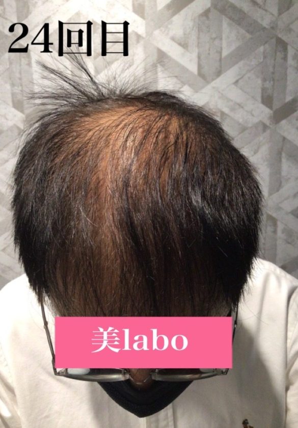 鍼と幹細胞培養上清液で髪のお悩み解決！：AFTER画像