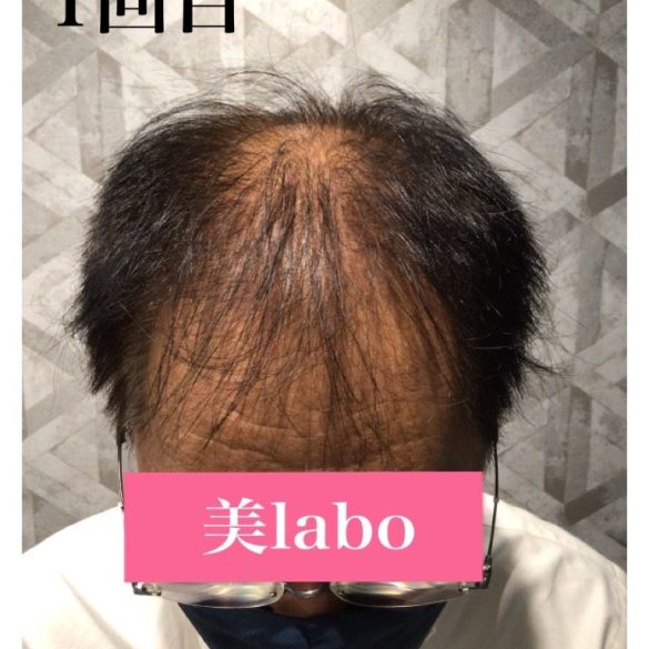 鍼と幹細胞培養上清液で髪のお悩み解決!:BEFORE画像