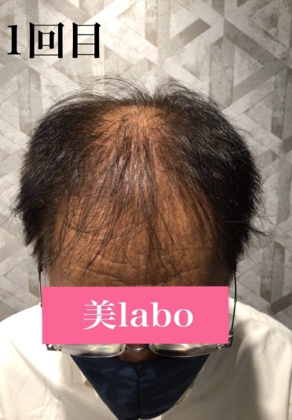 鍼と幹細胞培養上清液で髪のお悩み解決！：BEFORE画像