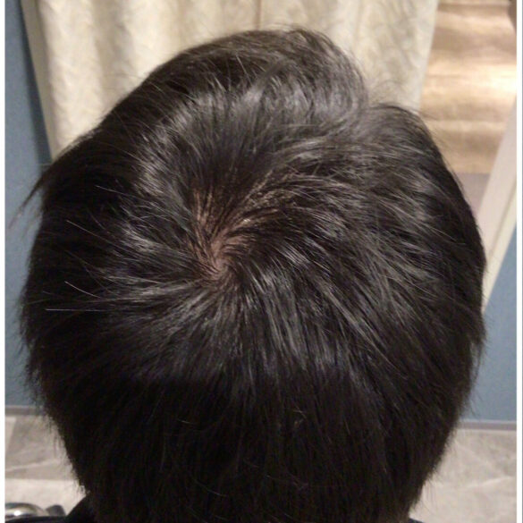 抜け毛、薄毛改善!:BEFORE画像