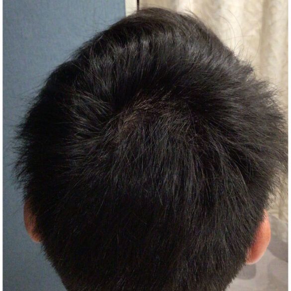 抜け毛、薄毛改善!:AFTER画像
